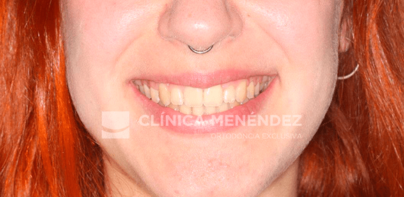 Cómo saber si necesito cirugía ortognática: síntomas, diagnóstico y soluciones