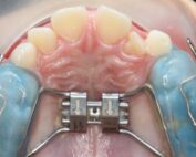 disyuntor de paladar