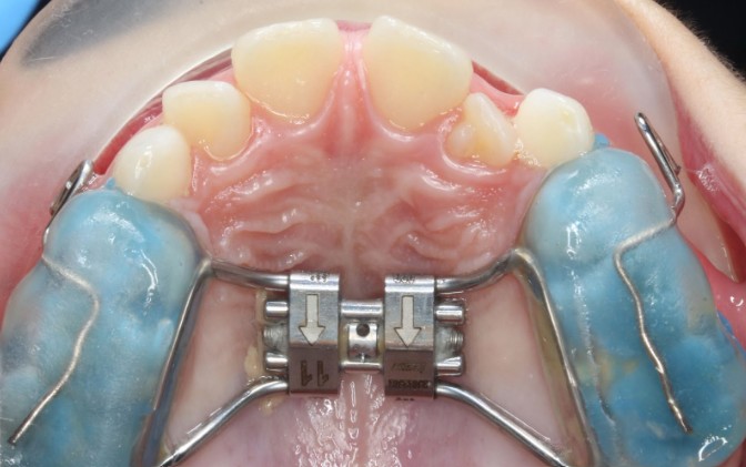 Disyuntor de paladar: qué es, para qué sirve y en qué casos se recomienda