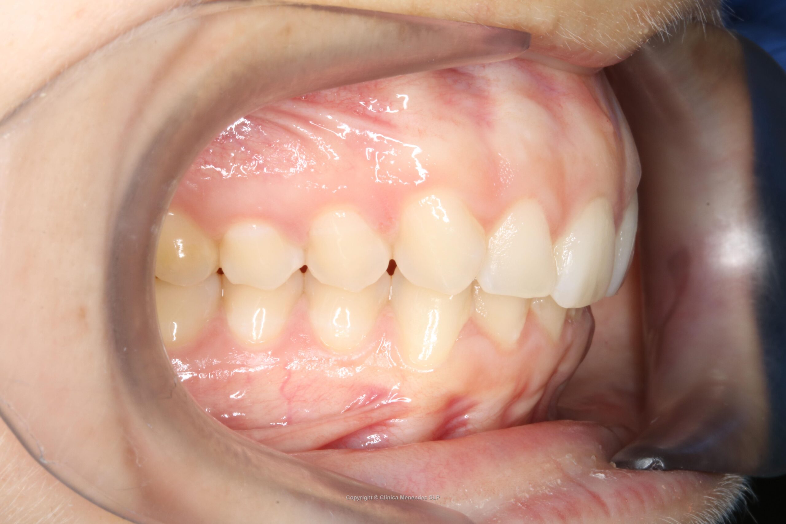 Ausencia dental trasera antes de realizar la mesialización de molares para cerrar huecos de dientes.