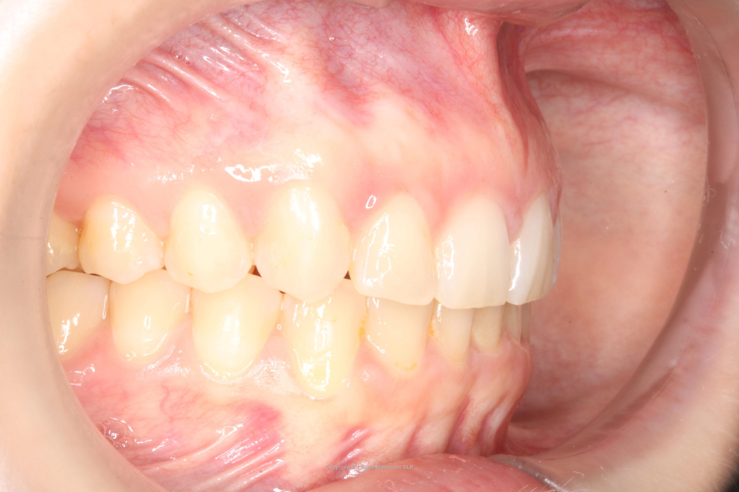 Cierre de espacio completado con éxito mediante mesialización de molares sin necesidad de implante dental.