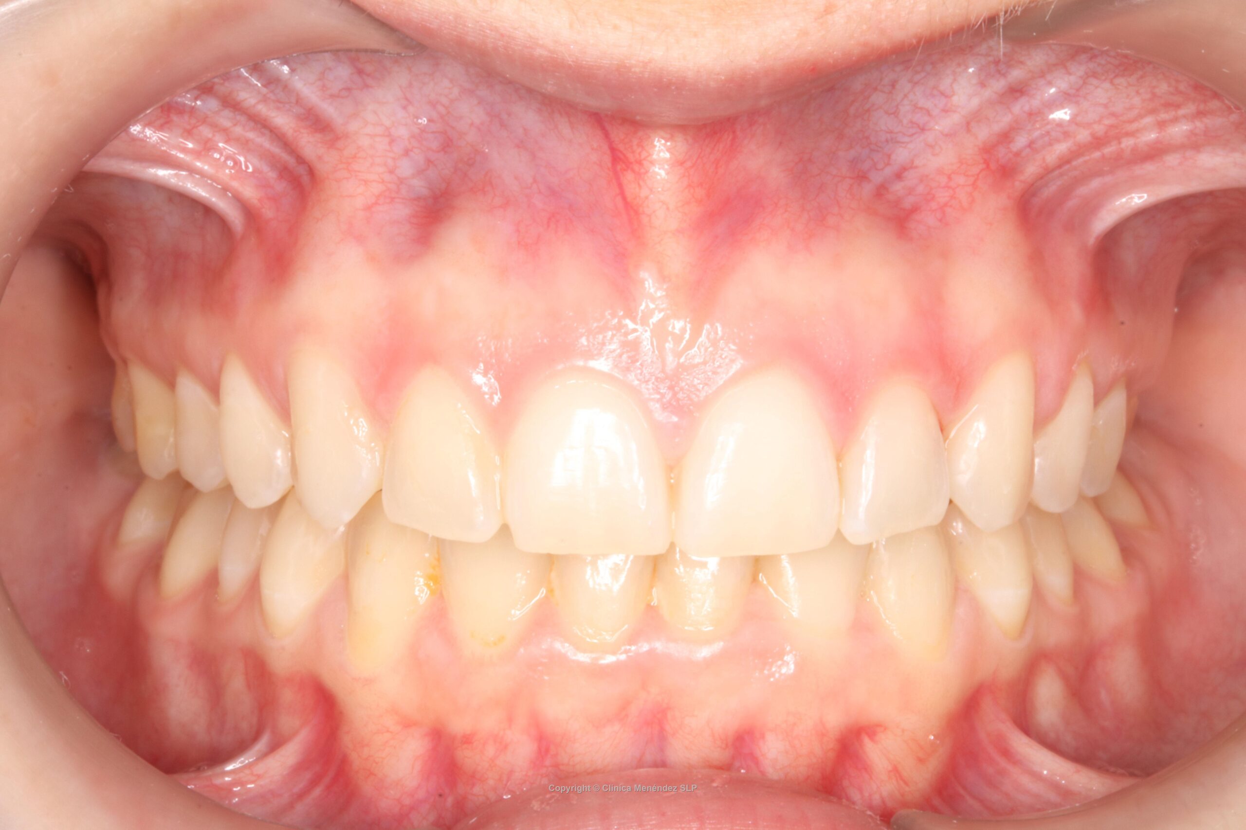 Cierre de espacio completado con éxito mediante mesialización de molares sin necesidad de implante dental.