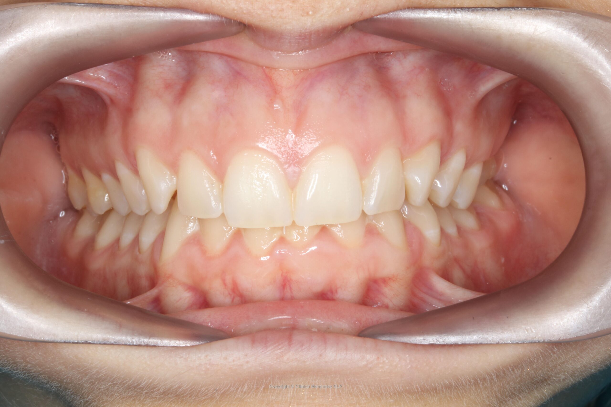 Ausencia dental trasera antes de realizar la mesialización de molares para cerrar huecos de dientes.