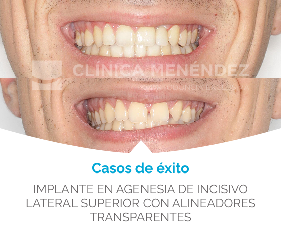 antes despues agenesia del incisivo lateral superior