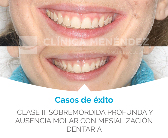 antes y despues maloclusión de Clase II molar y canina