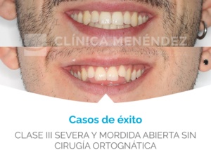 antes y despues maloclusión de Clase III