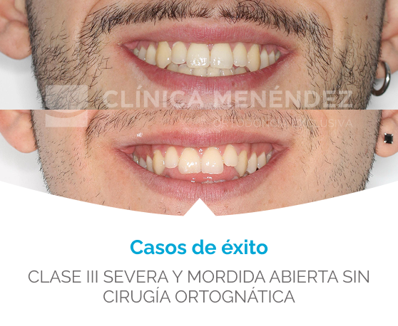 antes y despues maloclusión de Clase III