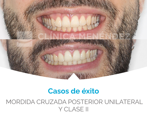 antes y despues mordida cruzada