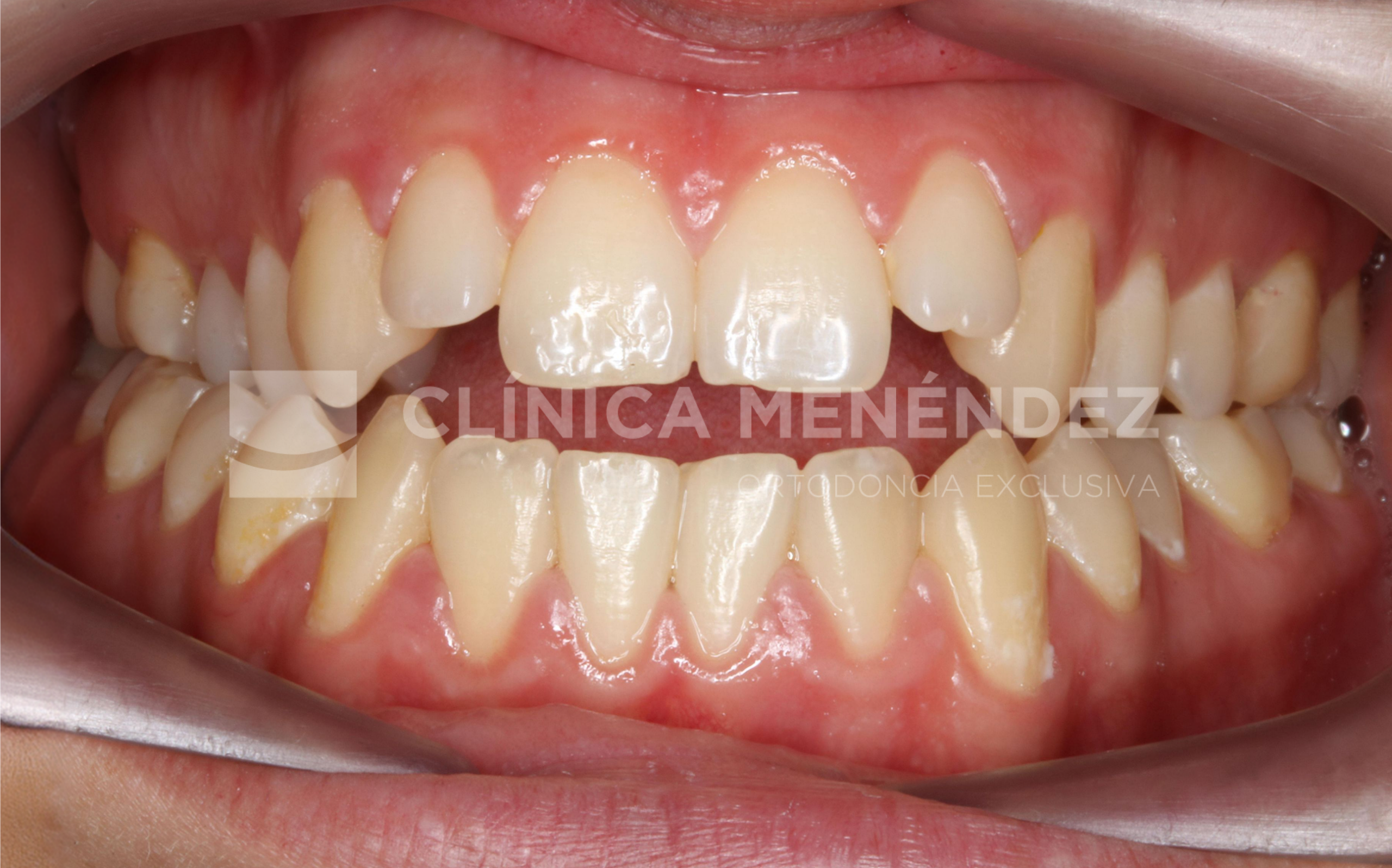 Oclusión alineada tras corregir la mordida abierta sin cirugía con ortodoncia invisible.