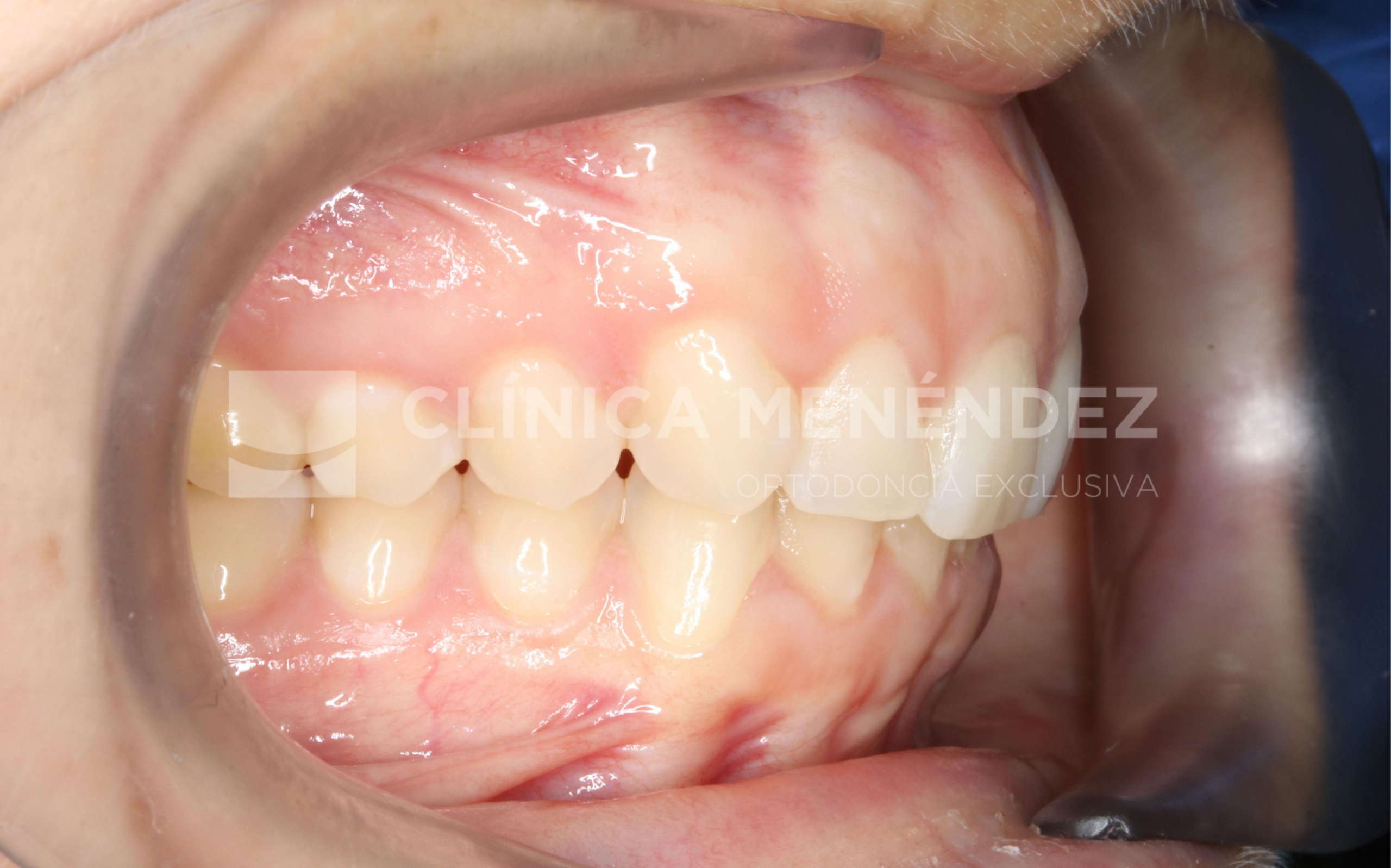 Sobremordida profunda y ausencia molar con mesialización dentaria mediante alineadores