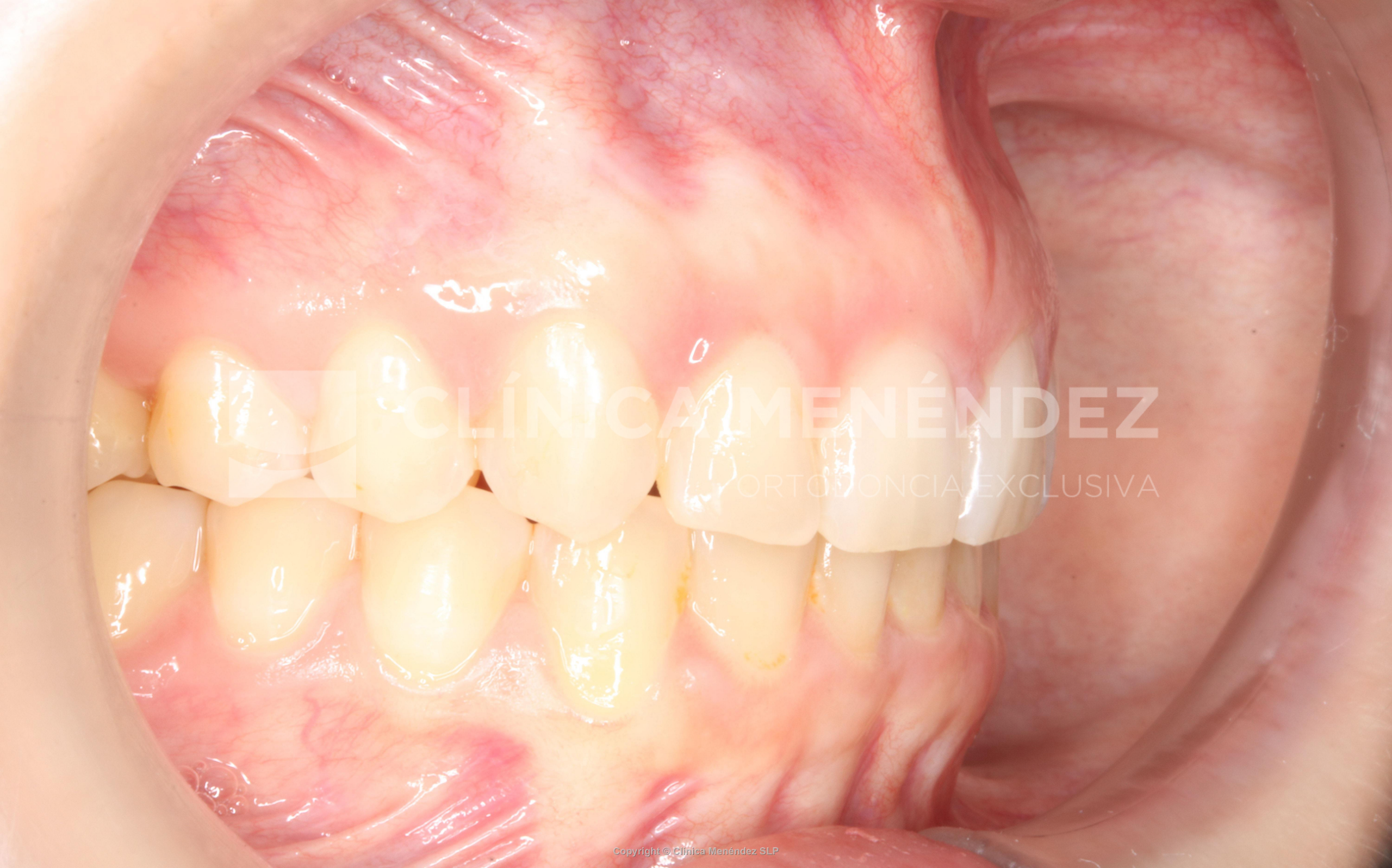 Sobremordida profunda y ausencia molar con mesialización dentaria mediante alineadores