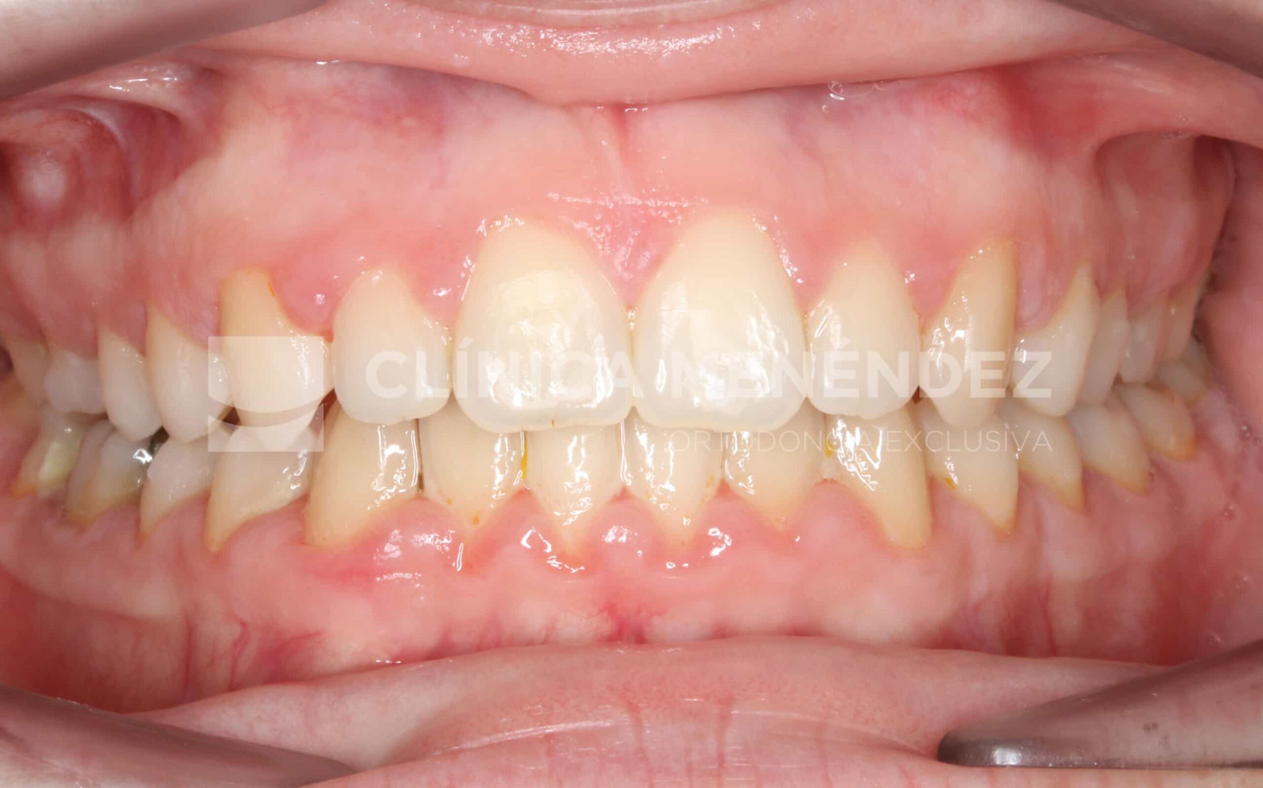 Antes y después de mordida abierta tratada con Invisalign.
