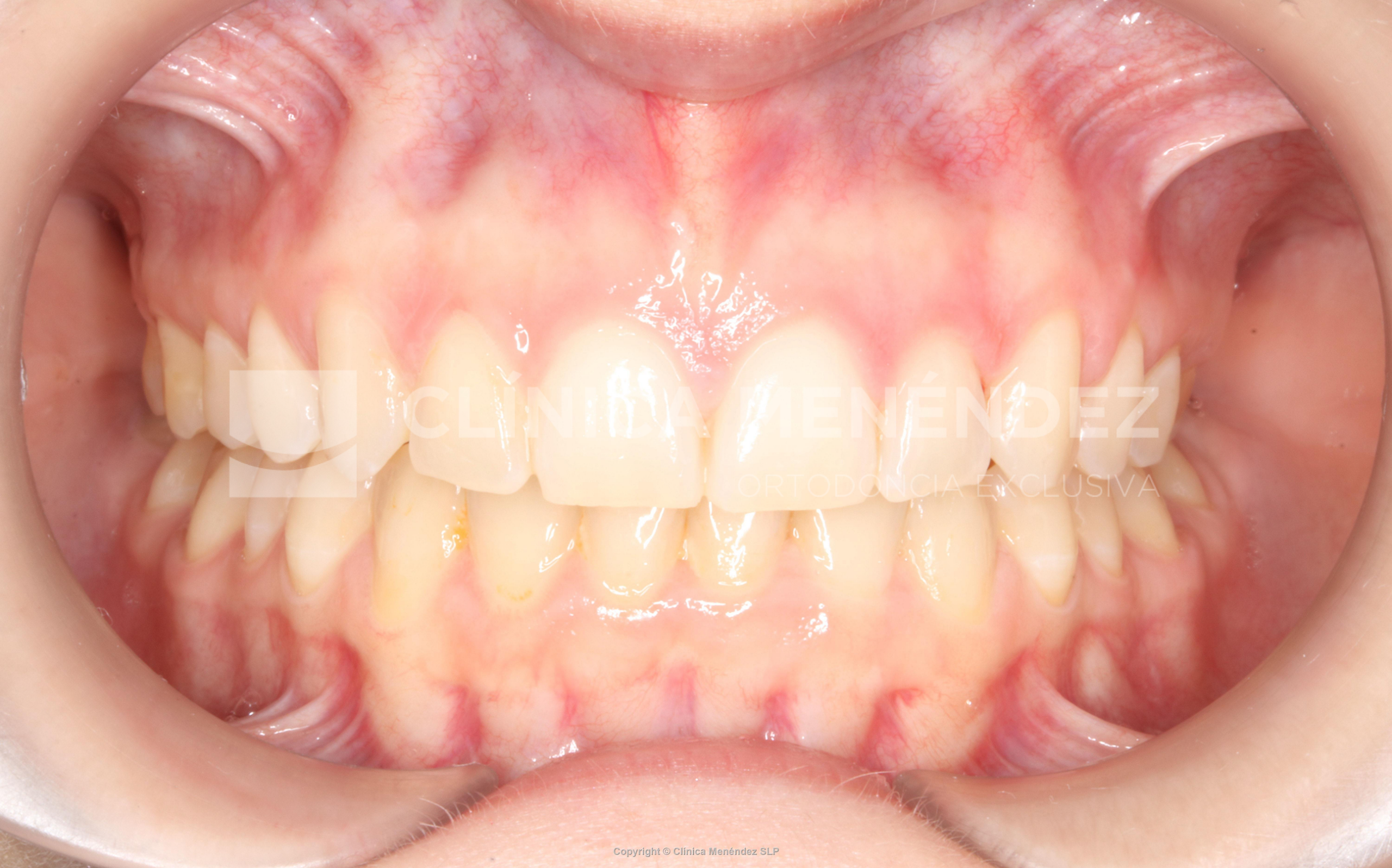 Sobremordida profunda y ausencia molar con mesialización dentaria mediante alineadores