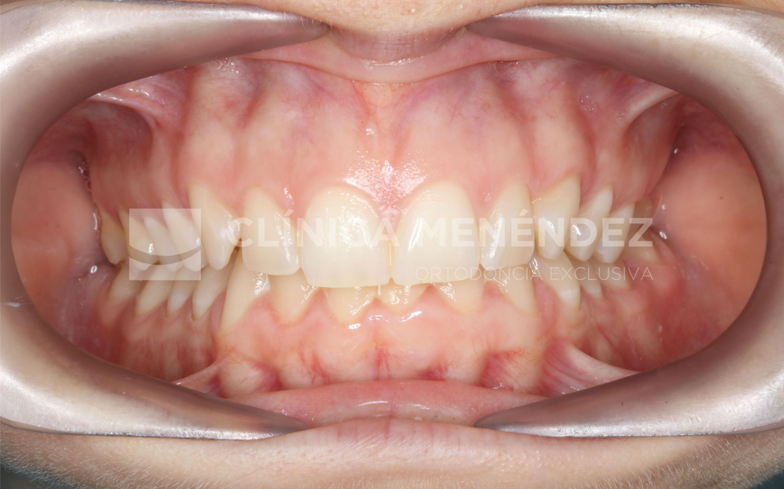 Sobremordida profunda y ausencia molar con mesialización dentaria mediante alineadores