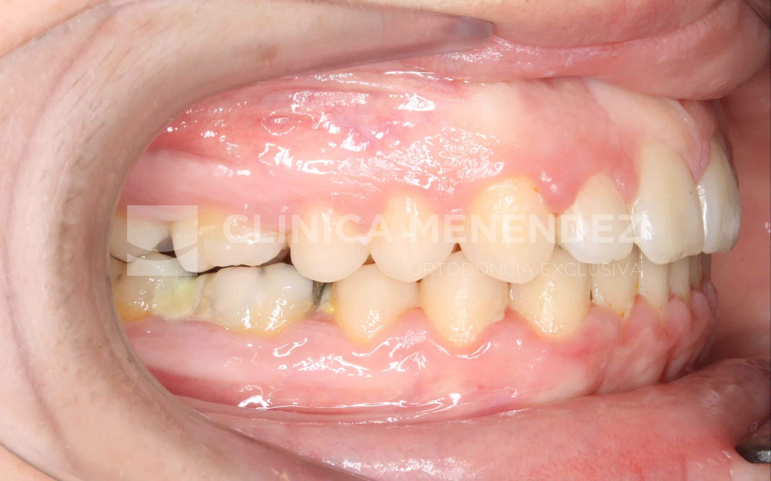 Antes y después de mordida abierta tratada con Invisalign.