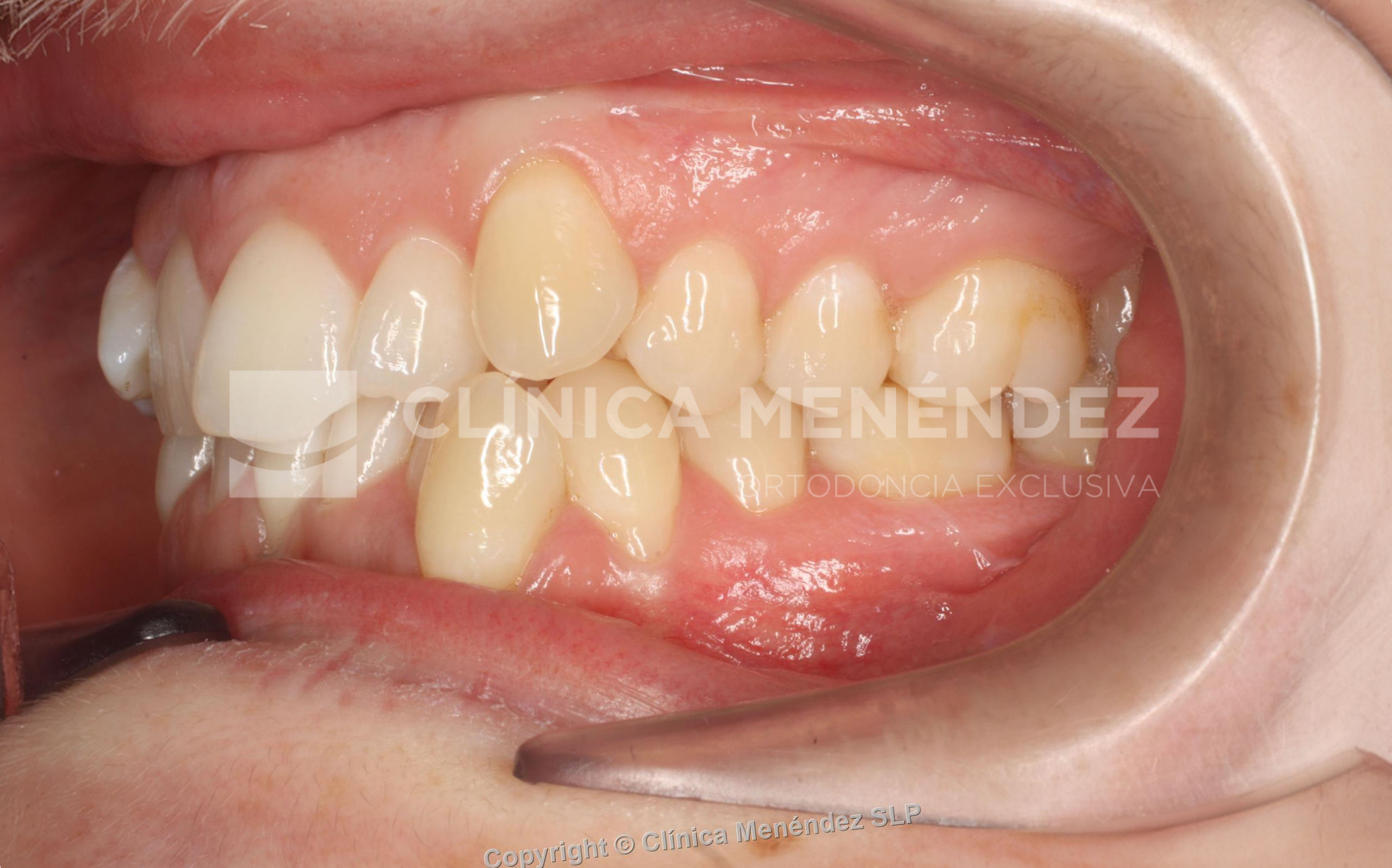 Antes y después de ortodoncia con alineadores transparentes y blanqueamiento dental en apiñamiento severo.