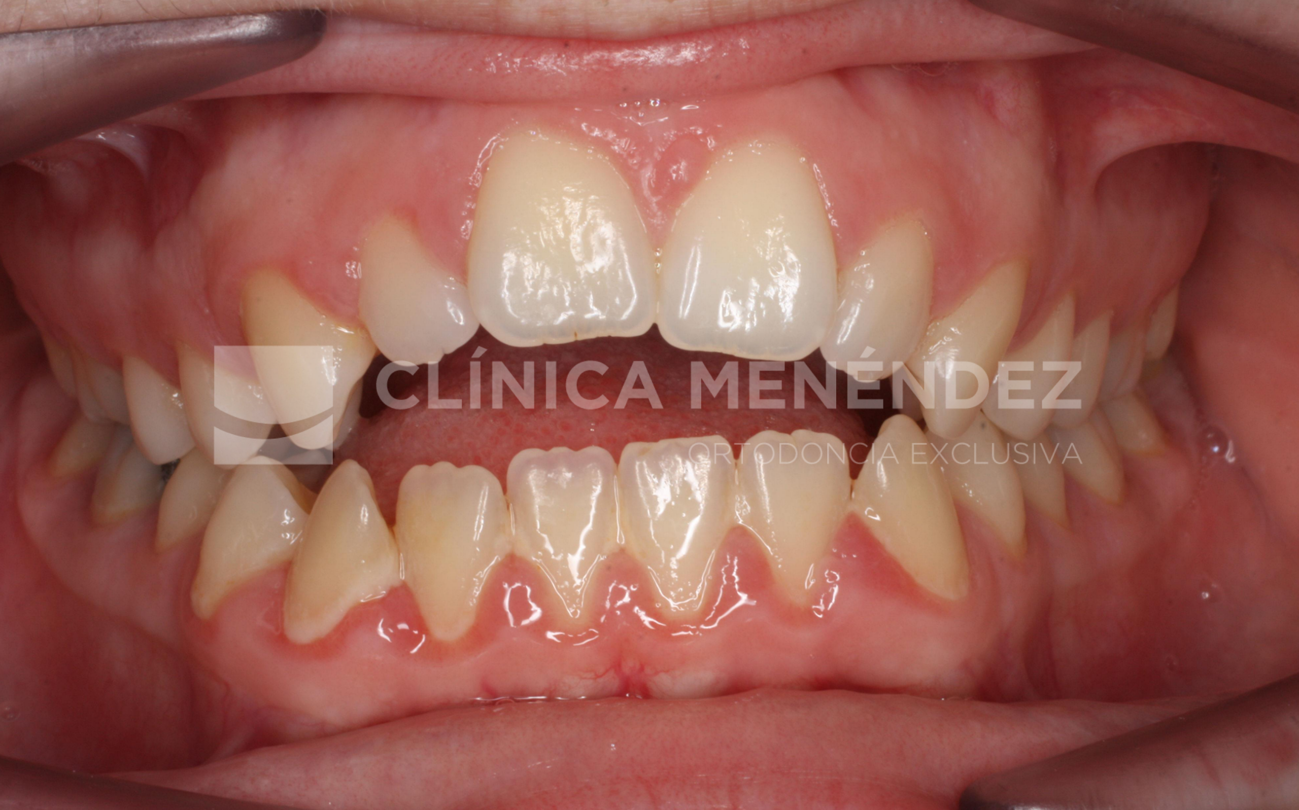 Antes y después de mordida abierta tratada con Invisalign.