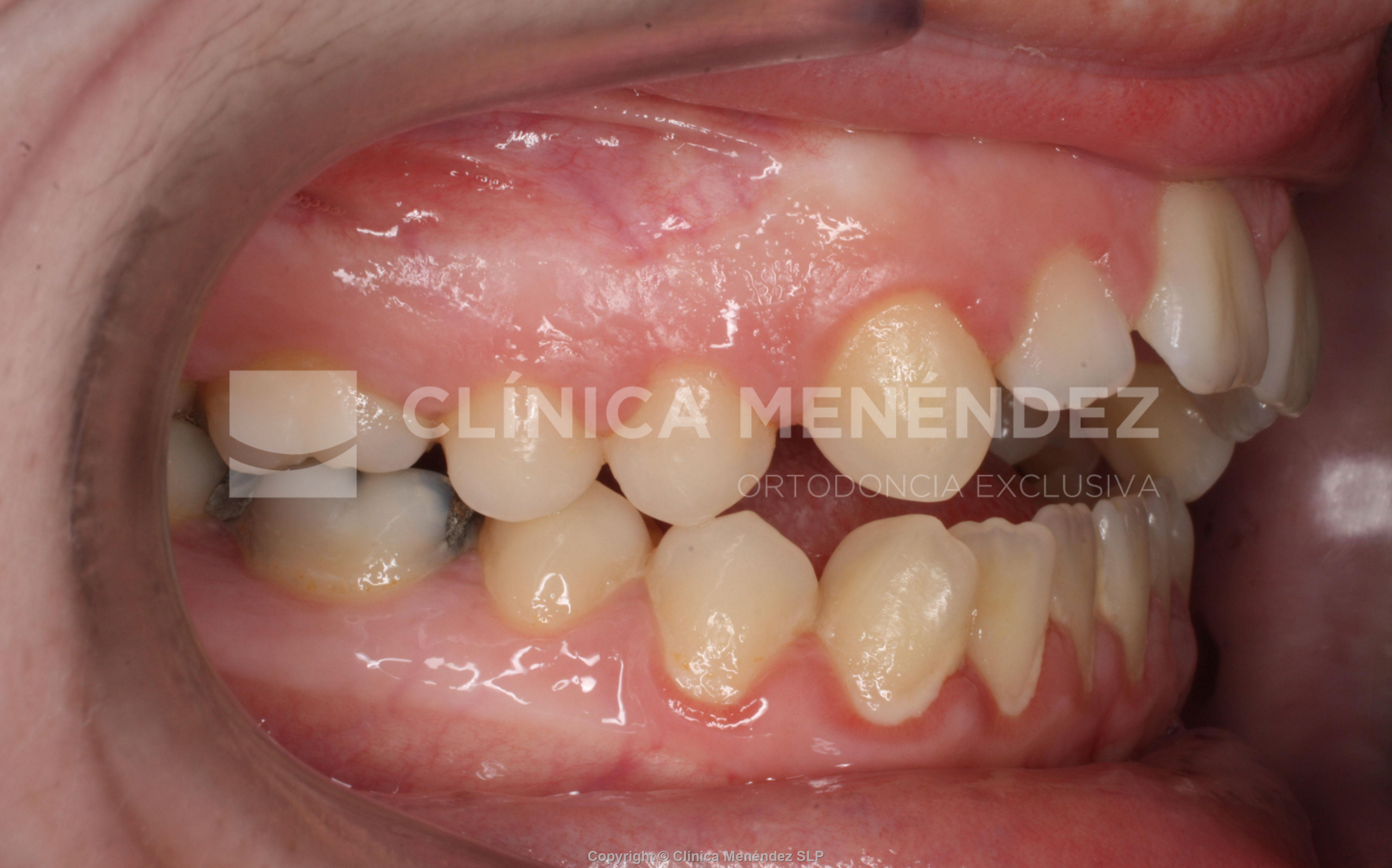 Antes y después de mordida abierta tratada con Invisalign.