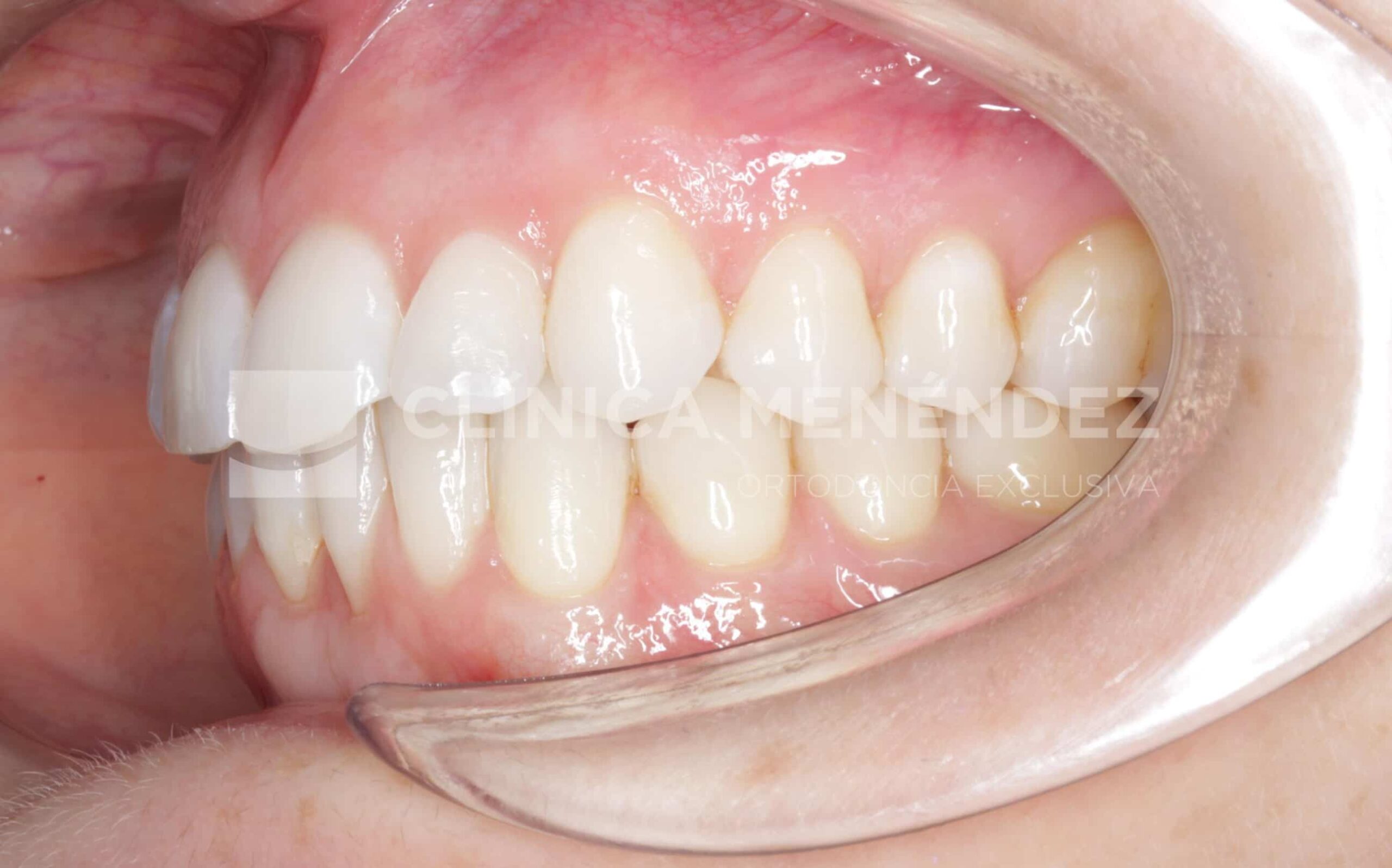 Antes y después de ortodoncia con alineadores transparentes y blanqueamiento dental en apiñamiento severo.