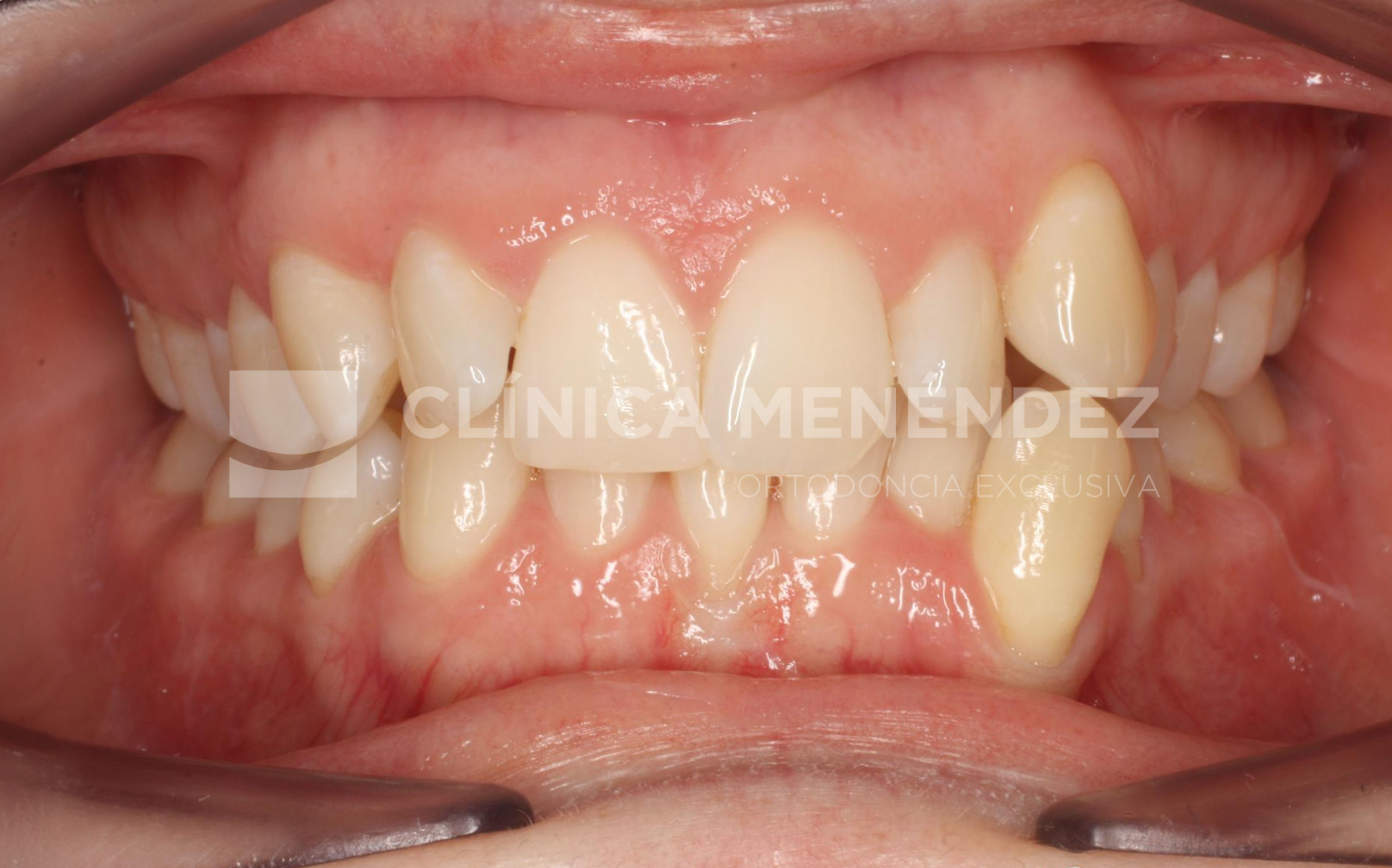 Antes y después de ortodoncia con alineadores transparentes y blanqueamiento dental en apiñamiento severo.