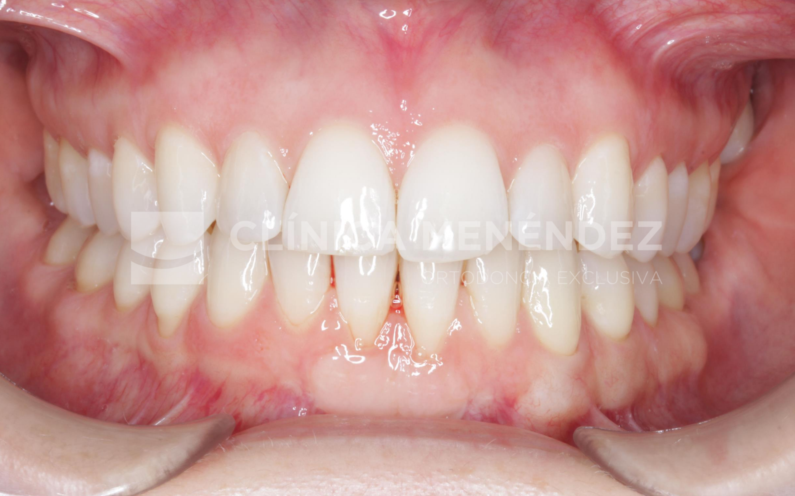 Antes y después de ortodoncia con alineadores transparentes y blanqueamiento dental en apiñamiento severo.