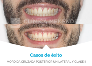casos reales mordida cruzada