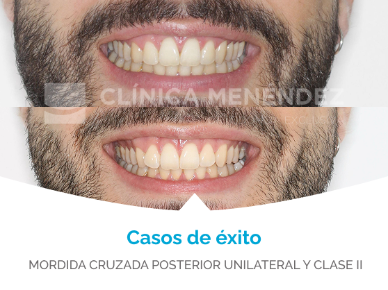 casos reales mordida cruzada
