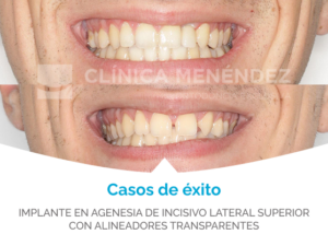 implante de agenesia fotos