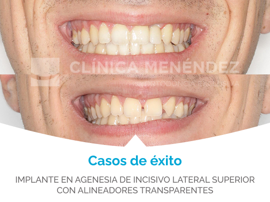 implante de agenesia fotos
